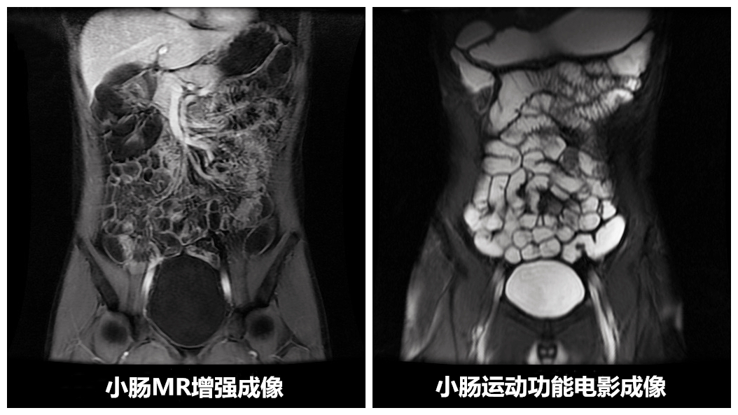 小腸MR增強成像_副本.jpg